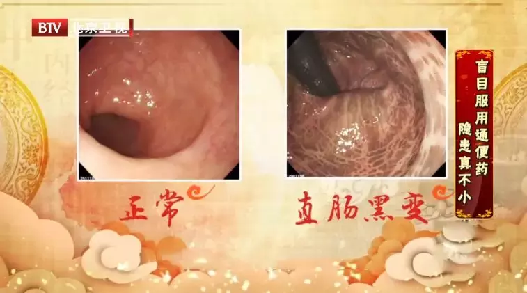 便秘不注意,可能得肠癌!中医教您不吃药治便秘的养生食疗方!