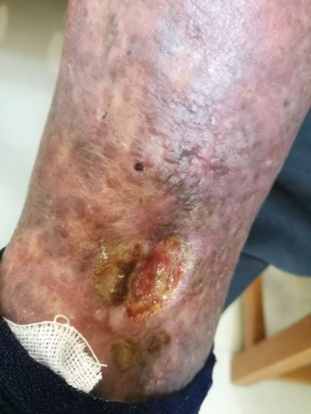 色素性紫癜性皮病是什么东东- MP头条