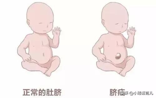 什么是小儿脐疝？一定需要动手术吗？小方法解决宝宝大问题