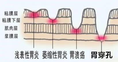 几分钟教你看懂胃镜和病理报告