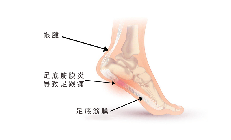 摆脱足跟痛，改变这些习惯更重要