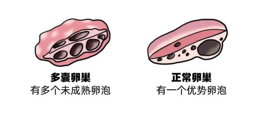 久备不孕？可能是多囊卵巢综合征的错！中医药调理两次圆她母亲梦