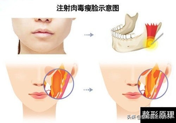 停止打瘦脸针后，会“反弹”吗？