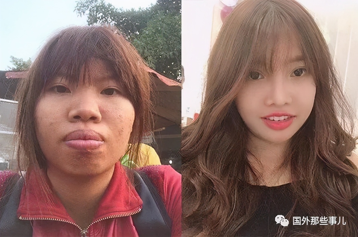 丑姑娘花85万整容后嫁富二代生完孩子后被抛弃如今又找到真爱