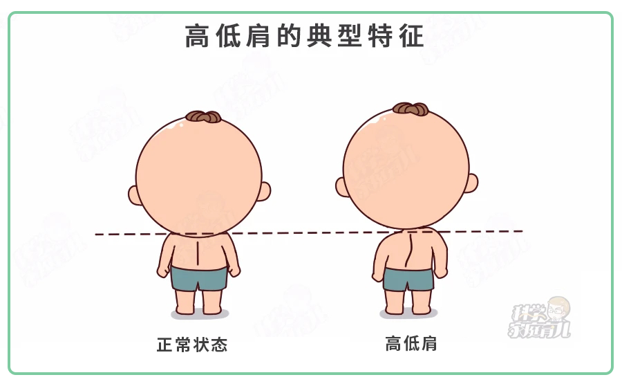 4岁就驼背？这种坐姿、运动对娃的伤害非常大，严重要手术