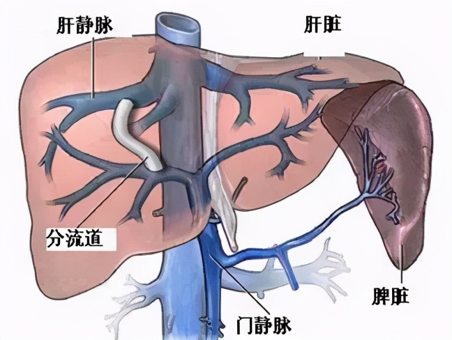 肝硬化合並門脈高壓 應該如何治療 臨牀醫生提出幾個解決辦法 麥吉醫學科普 Mdeditor