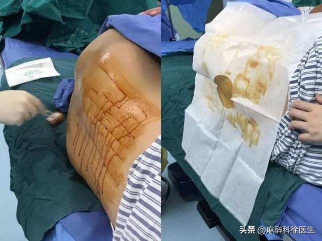半身麻醉是一种怎样的体验