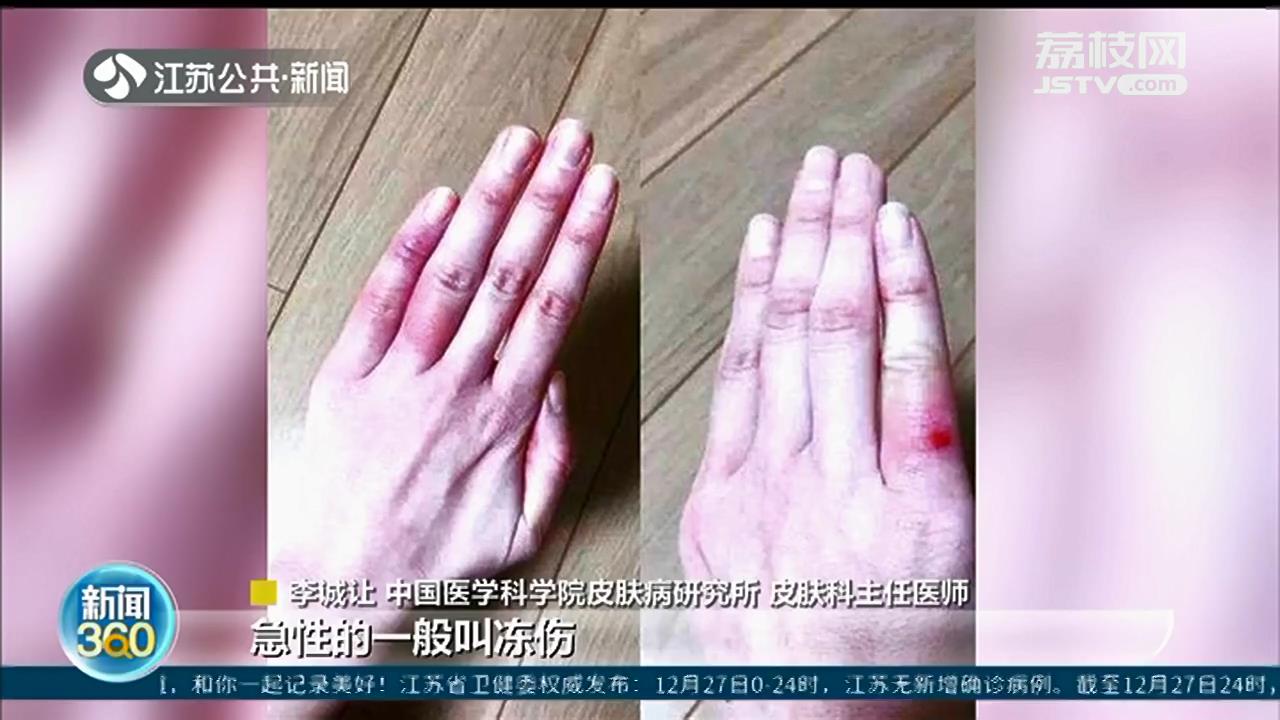 寒潮来袭，面部四肢易冻伤 这类衣服冬季要少穿