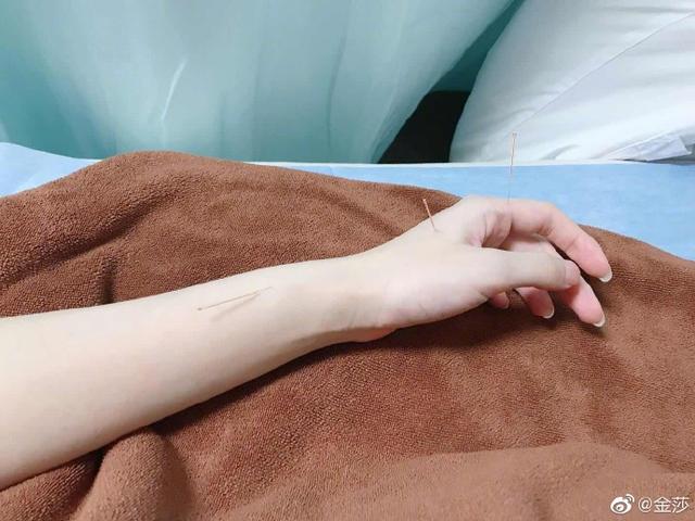 太拼！金莎参加姐姐综艺跳舞手四肢不协去针灸，满手银针让人心疼
