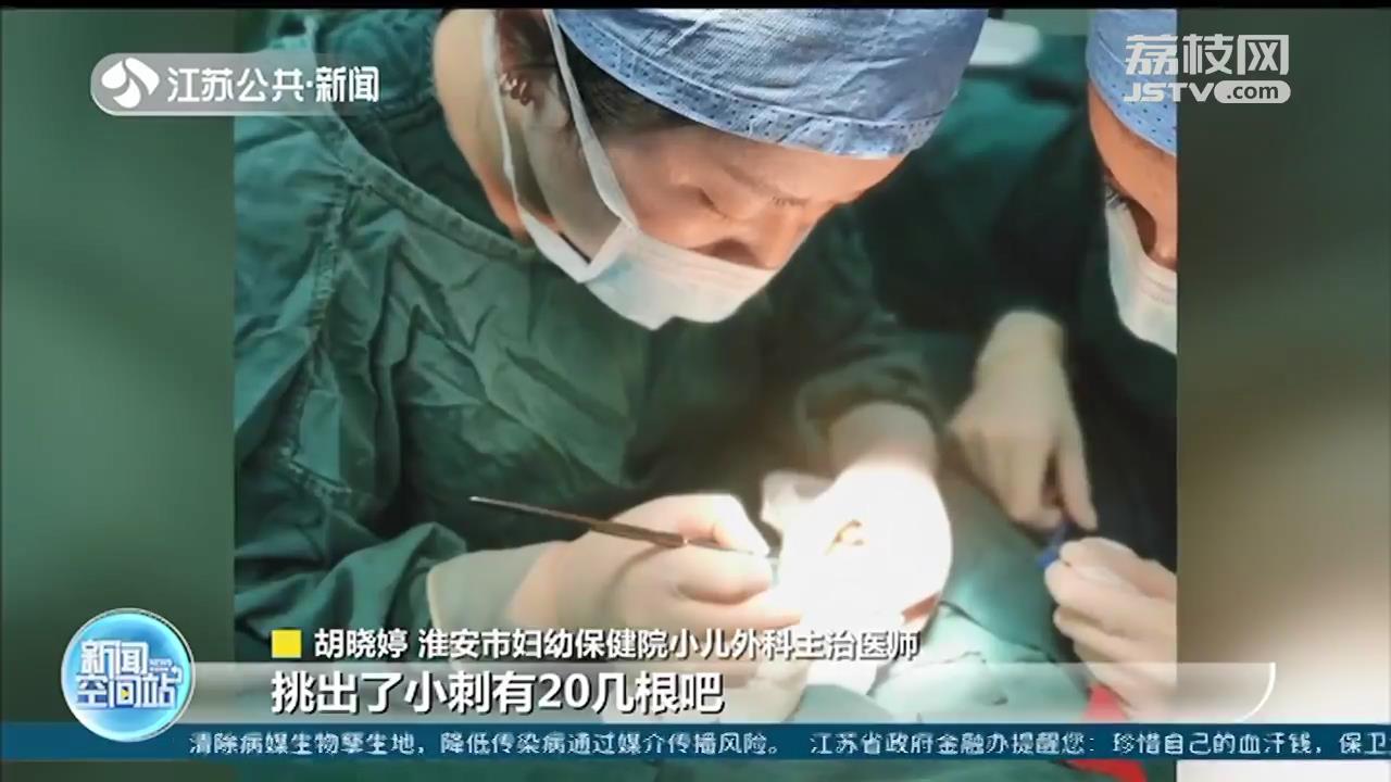 淮安四岁女童手抓仙人球 医生取出20多根刺