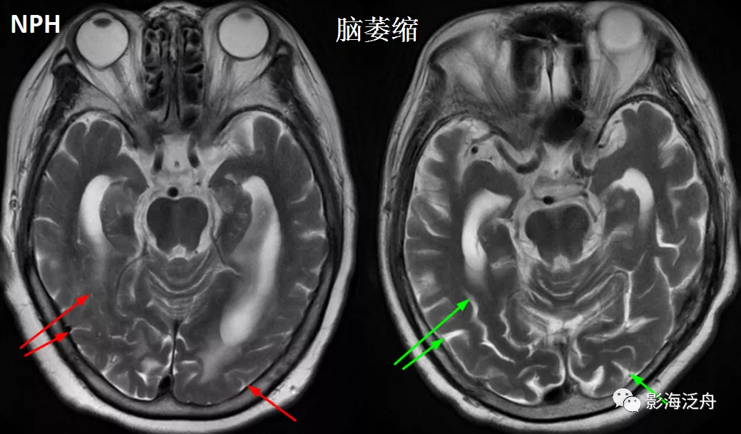 小心误诊，这可不是单纯的脑萎缩