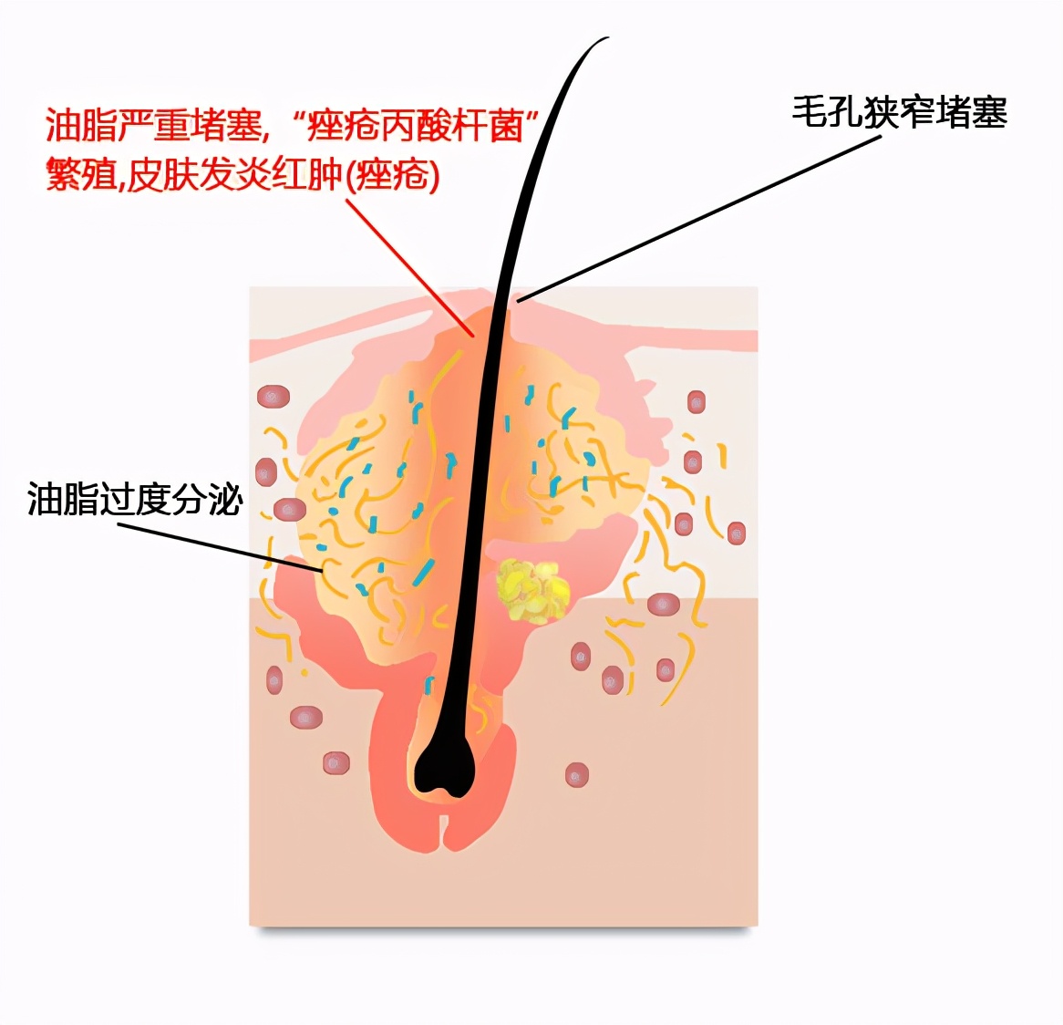 对我们的皮肤是无害的,但大量繁殖就会堵塞我们的毛囊口,还会释放出过