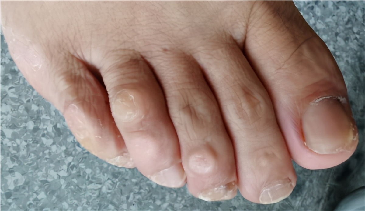 经过检查考虑是指节垫,仔细询问病史,家里并没有其他人有这种情况.