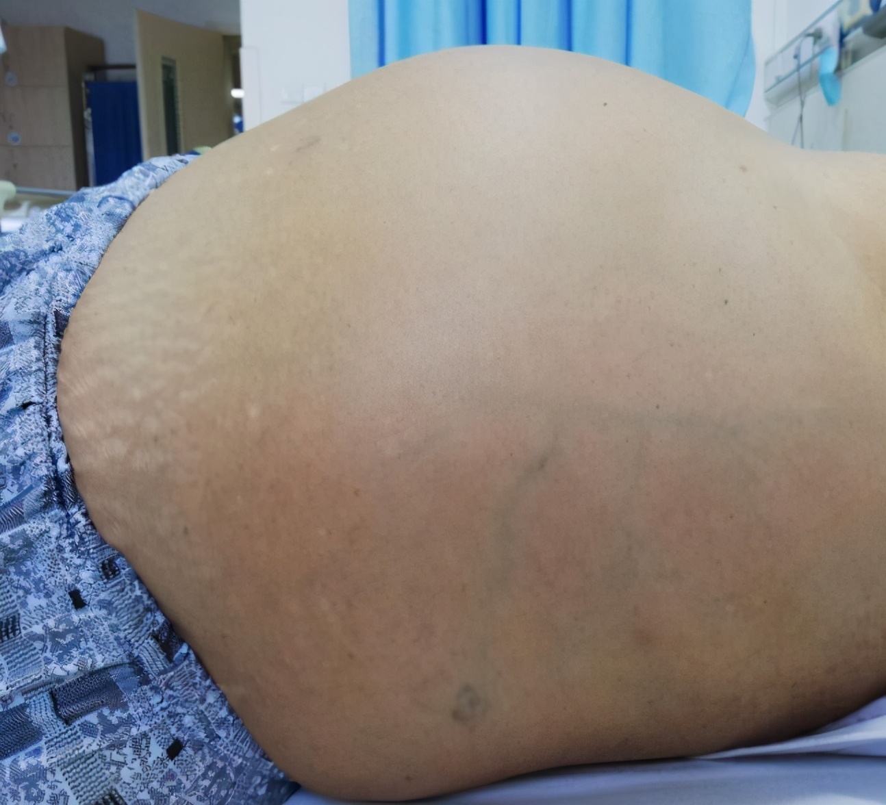 肝硬化肝腹水没救了吗 医生 对症治疗能治好 别灰心 肝病王医生 Mdeditor