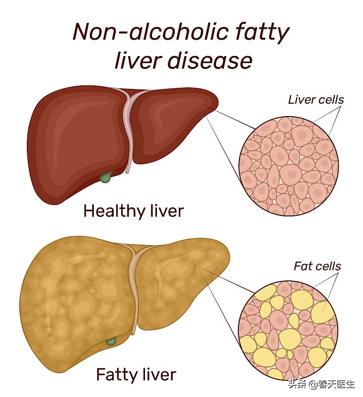 哪種糖最對身體危害最大？ 研究：果糖、蔗糖不降低脂肪肝肝癌機率