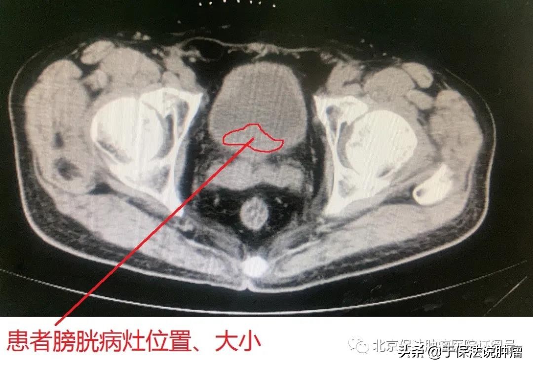 65岁膀胱癌患者不愿手术，经超微创治疗，血尿消失肿瘤缩小