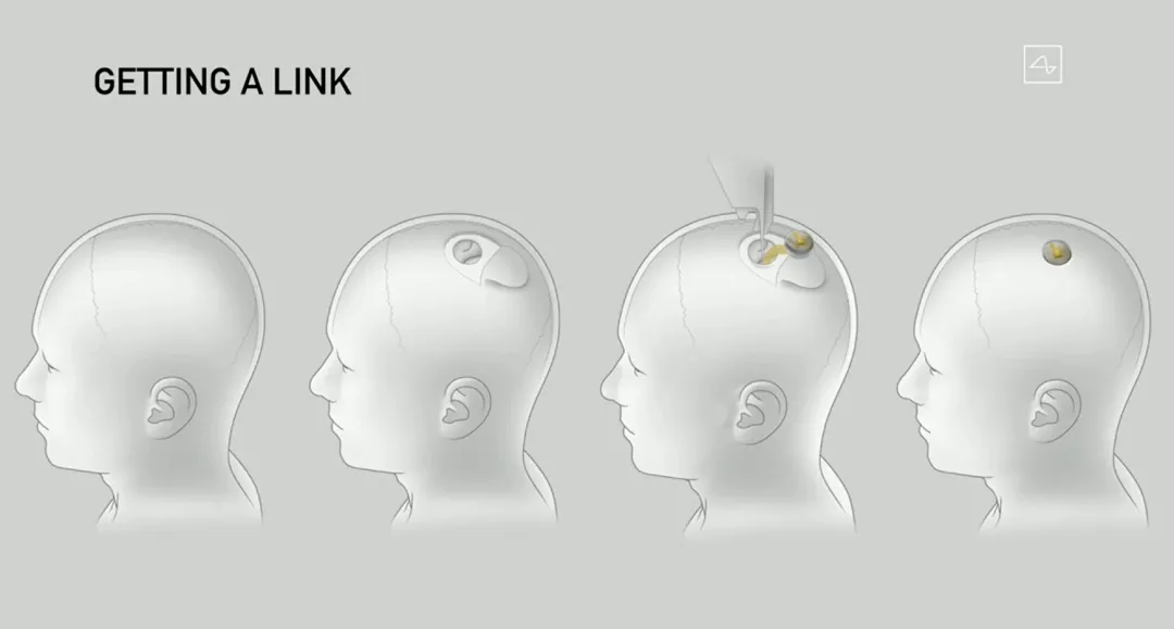 脑机接口专利哪家强？脑机芯片成功植入猪脑，人脑实验蓄势待发