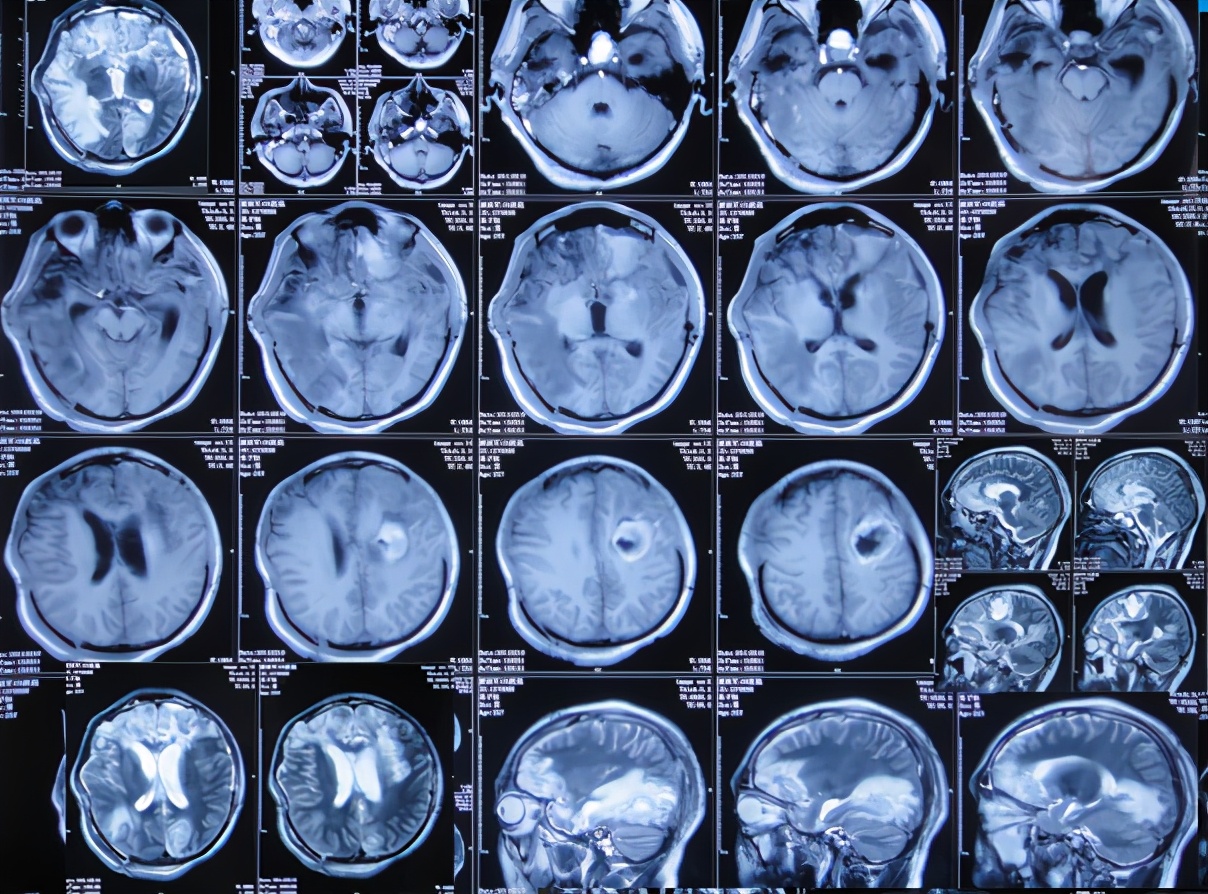 haodf:8:naoyan-->颅内感染 !--haodf:/8:naoyan-->和脑积水