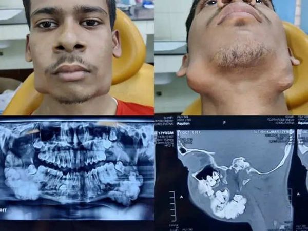 印度17岁少年长出82颗牙齿，下巴肿胀变形，医生花3小时做手术终于拔除