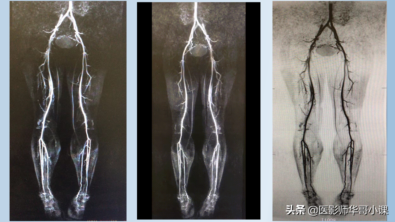 磁共振非增强双下肢血管MRA