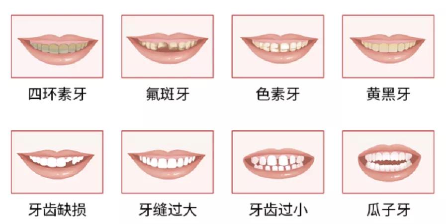 除了烤瓷牙、全瓷牙，或许贴面更适合想要快速变美的你