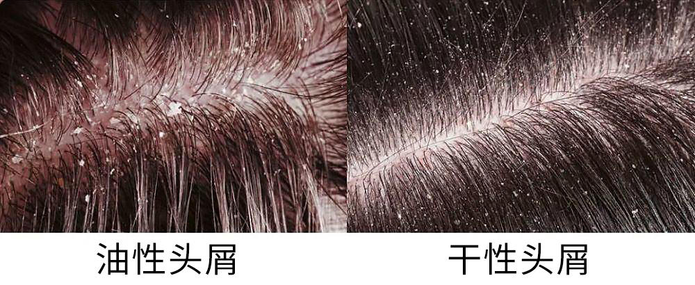 4月来临后 猛然发现头皮屑增多是怎么回事 Mp头条