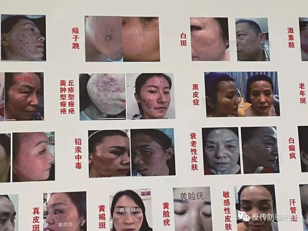 宣称能让人“返老还童”快速年轻的“初颜玉”代理模式或涉嫌传销