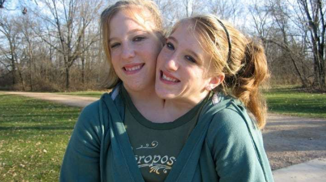 连体人揭秘：其中一个意外去世了，另一个还能