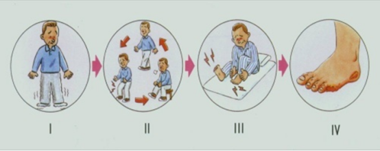 腿凉、麻木？下肢血管又堵塞！作为子女，这4点应及时督促