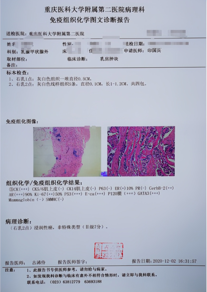 手把手教你读懂乳腺癌术后病理报告如何解读乳腺癌病理报告