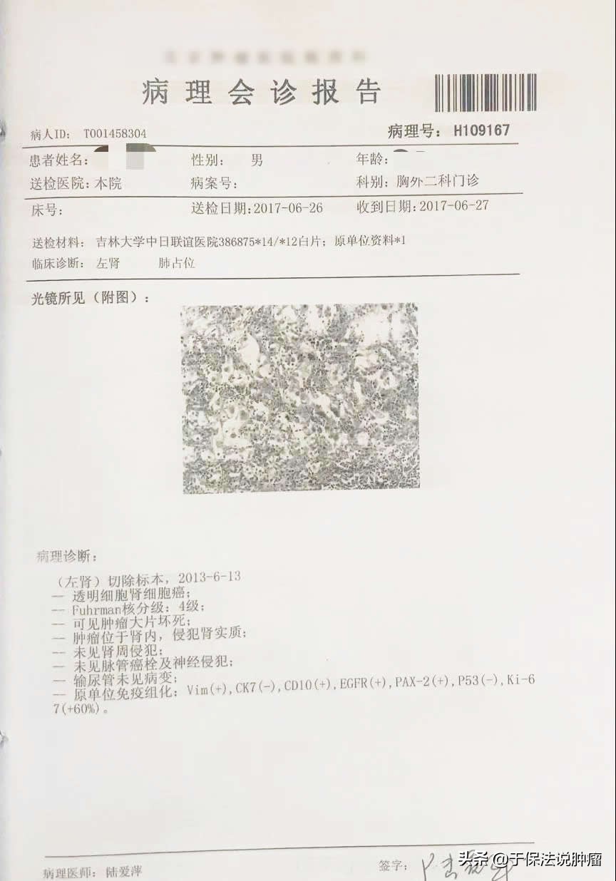 肾透明细胞癌术后肺转移患者，经缓释库治疗，已带瘤生存5年