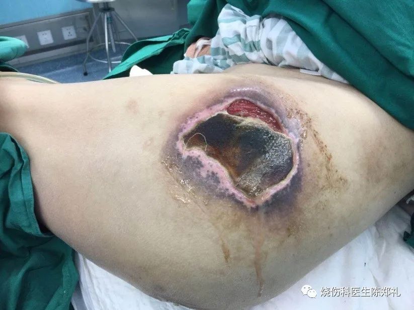 褥疮系列3：褥疮、窦道换药过程视频+图解
