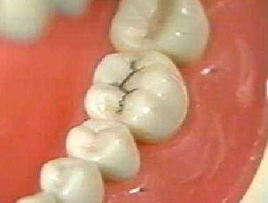 牙齿上的黑色污垢是怎么来的？要怎么清除？