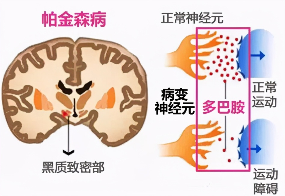 抗帕金森病药物及其分类，这2大类要知道