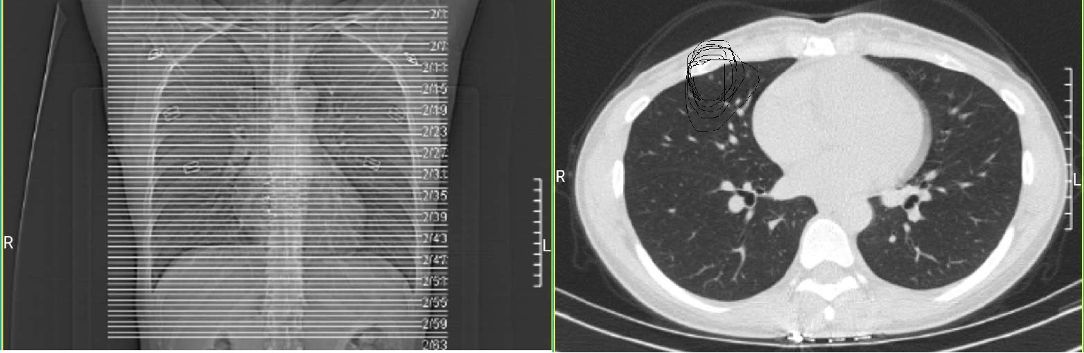 肺部体检为啥做CT？胸片为啥不行？用切西瓜告诉你两者的区别