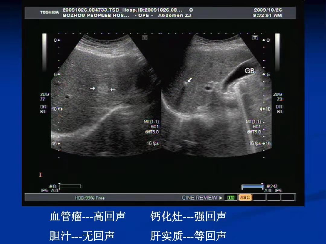 图1-7、8 肝硬化声像图-临床医学-医学