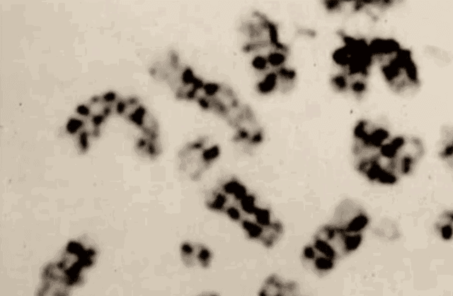 日本嚴重核泄漏事件，被輻射人83天身體腐爛去世