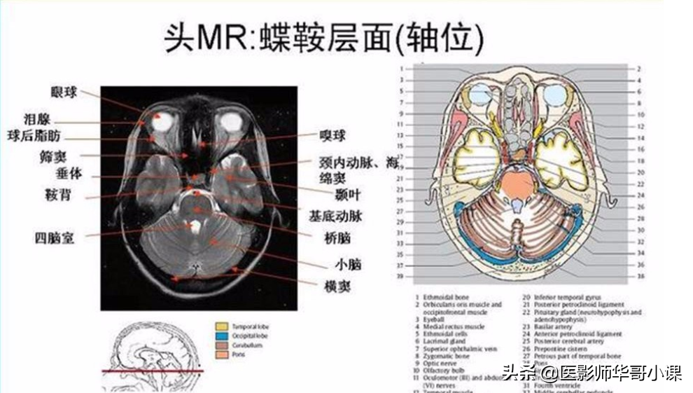 头颅磁共振（MRI）解剖--精品图集