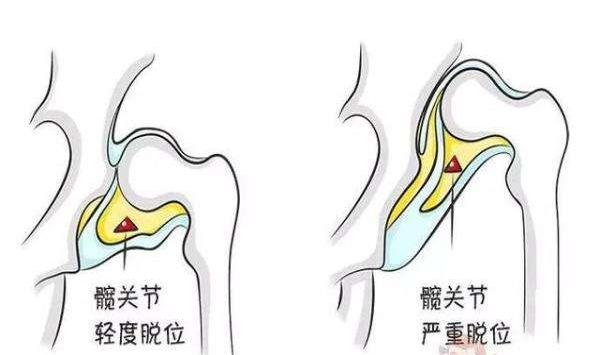 狗狗腿腳不利索，很可能是髖關節發育不良