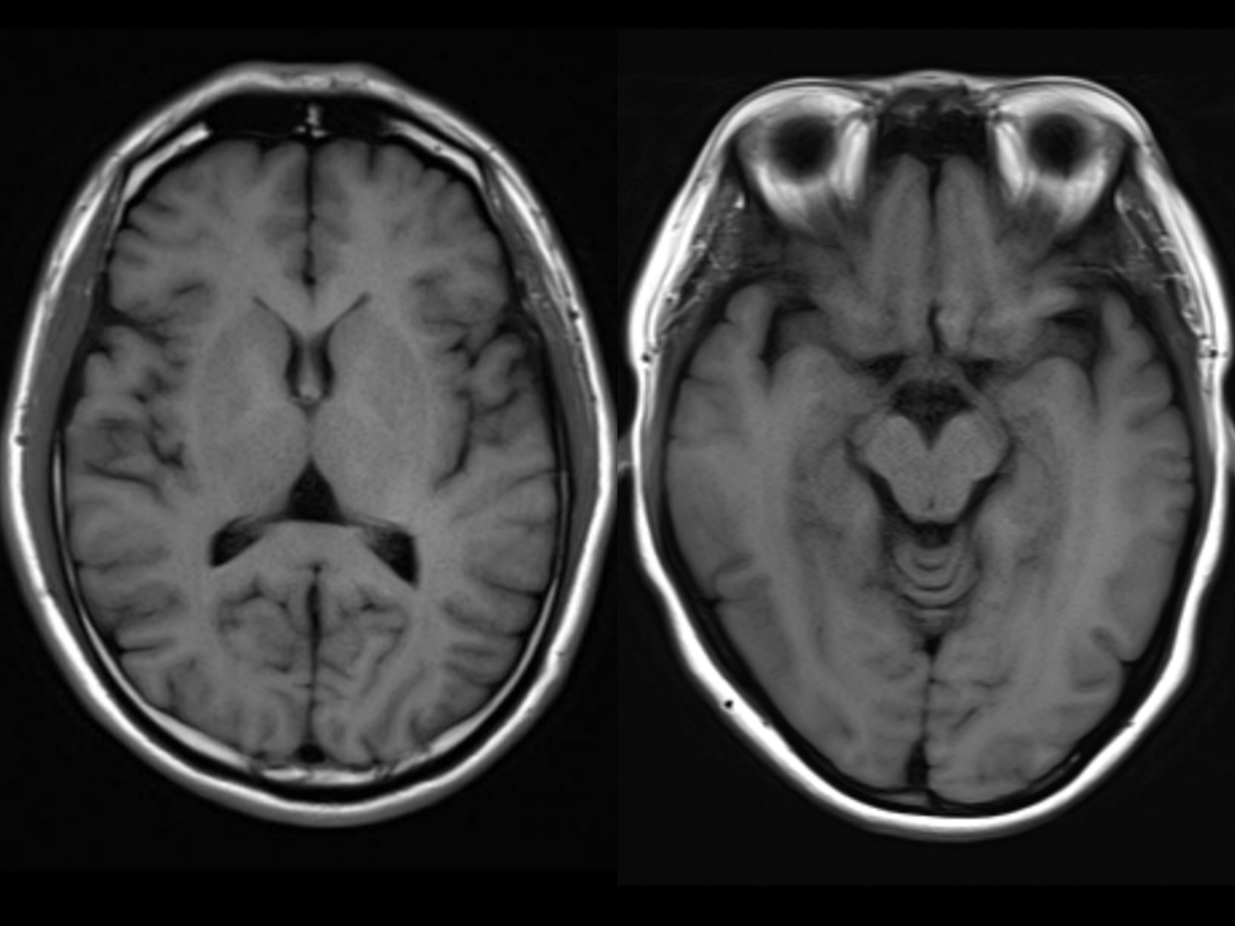 ct检查正常的大脑先来看看正常的大脑图像:正常大脑和萎缩的大脑,ct和
