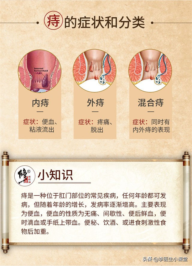 痔疮怎么办才好得了痔疮怎么办2个方法这么用痔疮肉球没有了