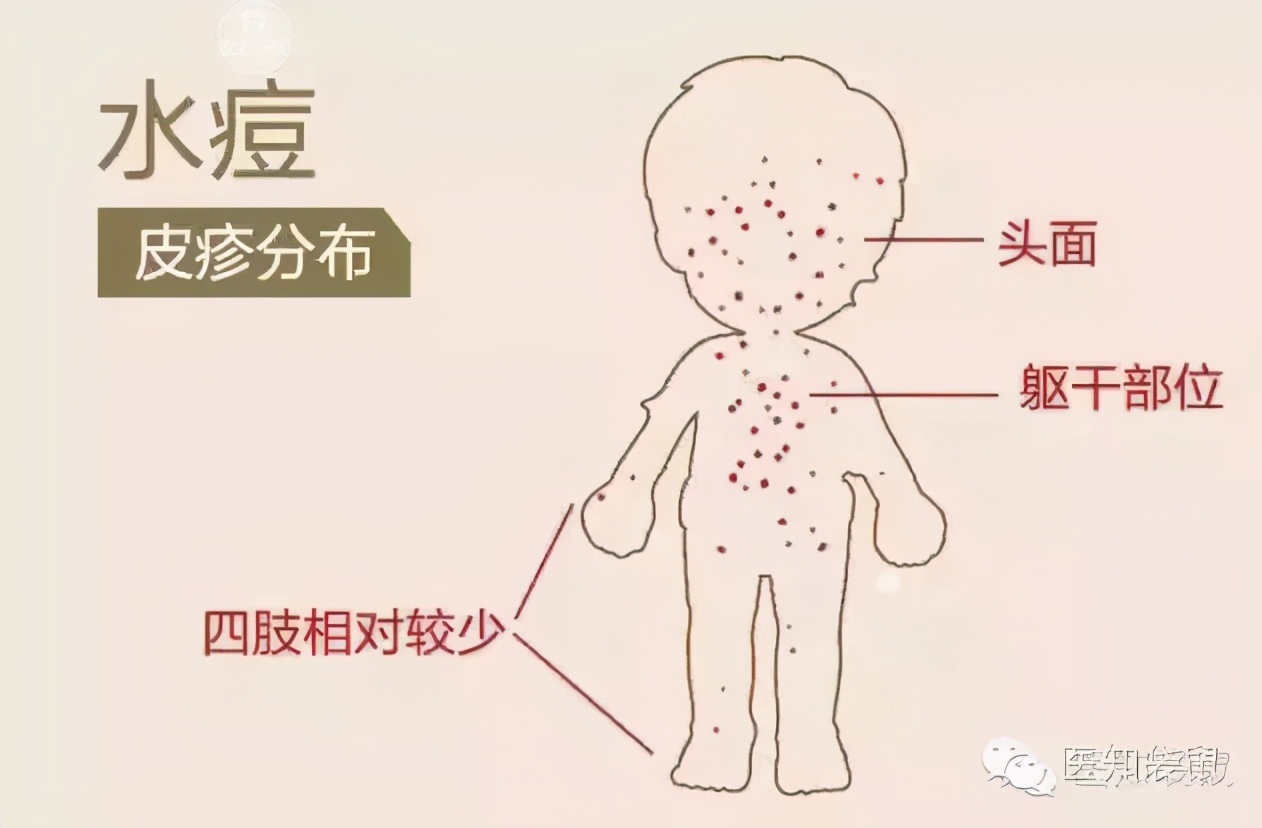 水痘高发期别大意严重或致脑炎这个疫苗得安排