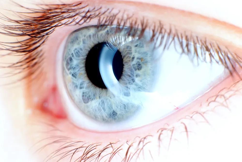 角膜塑形镜，真的能矫正近视吗？