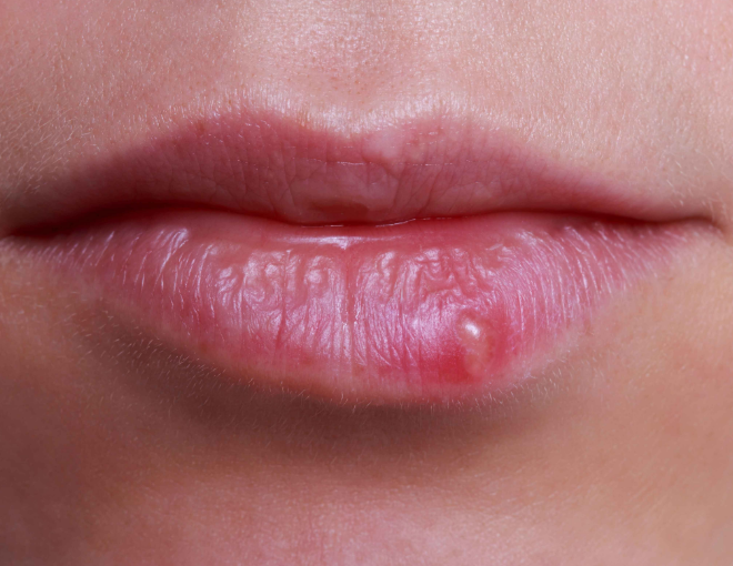 嘴唇上总是起泡，可能是这5个行为导致的，不能轻视