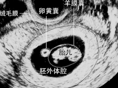 孕早期b超图解,准妈妈需知的7个指标