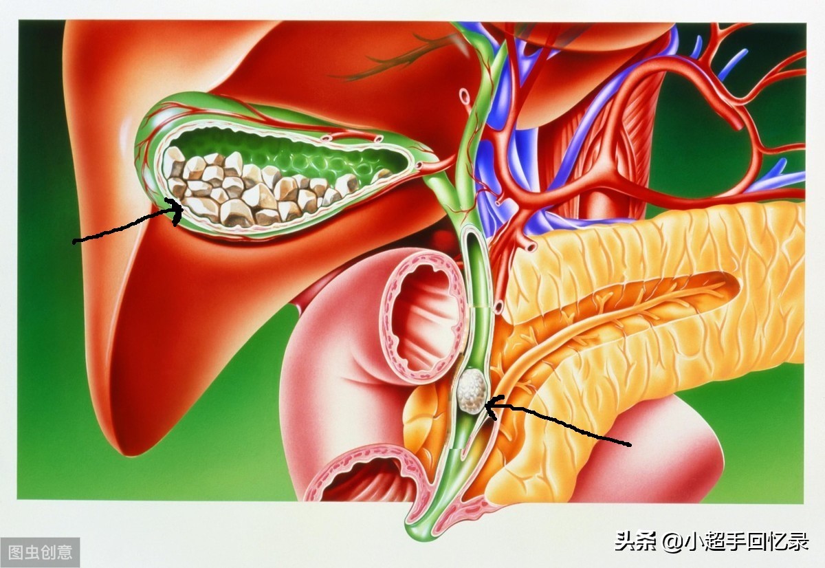如何预防和治疗——三、胆结石-第4张图片-农百科