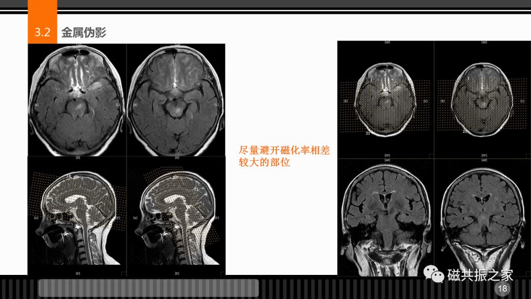 磁共振常见伪影及策略