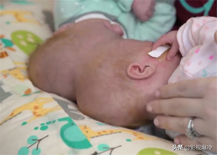 “最奇特的双胞胎”，一个死了另一个会怎样？第3对给出答案