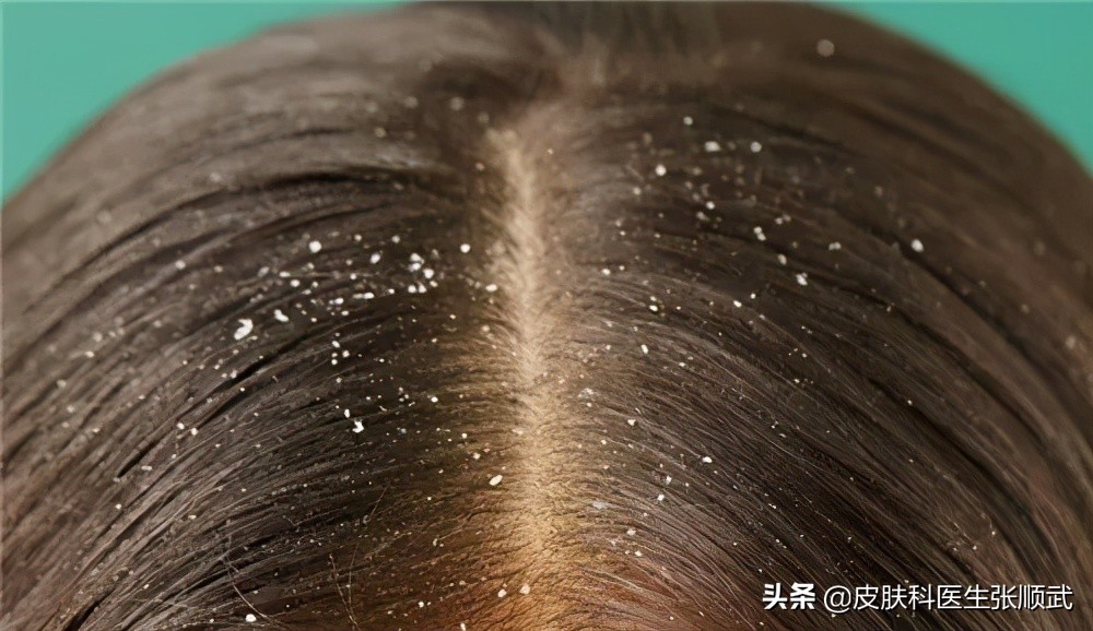 有头皮屑要重视：这里介绍与头皮屑相关的5个皮肤病，包含银屑病
