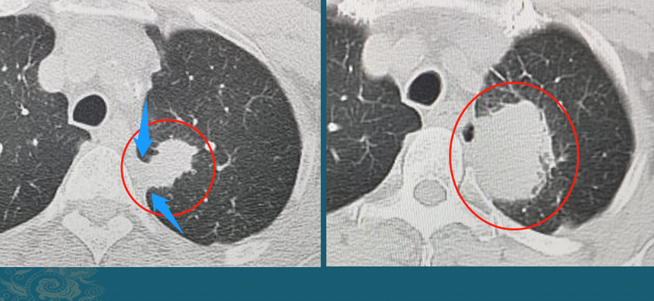 老人长5个肺癌，都不一样，有2个扩散，肺癌不能治愈吗？